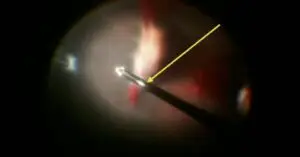 Eye Tube